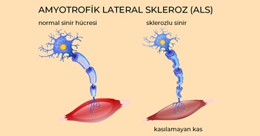 Amyotrofik lateral skleroz (ALS)