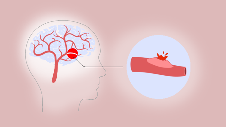 Beyin kanaması nedir? Beyin kanaması sonrası fizik tedavinin önemi?