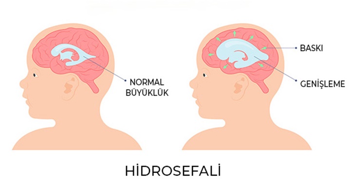Hidrosefali Nedir? Hidrosefali’de Fizik Tedavi