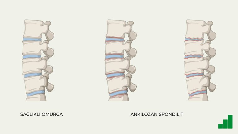Ankilozan Spondilit’te Fizik Tedavi ve Rehabilitasyon Anlam ve Önemi
