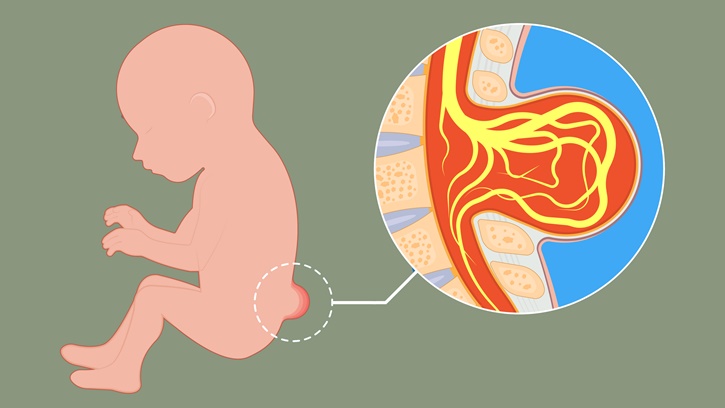 Spina Bifida Nedir? Sipina Bifida’da Fizik Tedavi