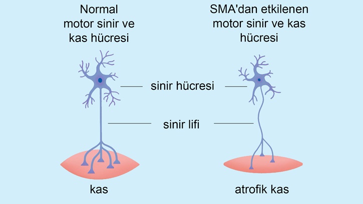 SMA Nedir?